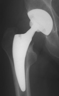 Bewährte Implantate in Hüft- und Knieendoprothetik